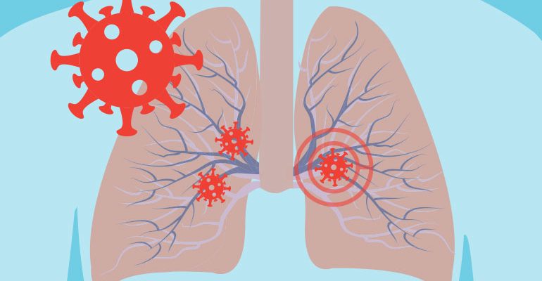 Třetina pacientů hospitalizovaných s covid-19 má rok po infekci změny v plicích 1
